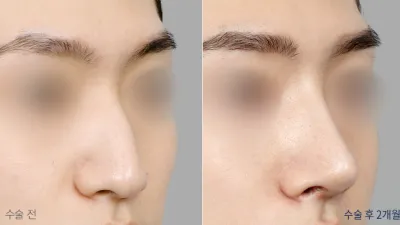 Before & After