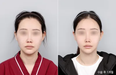 Before & After