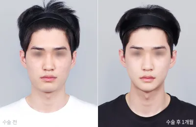 Before & After