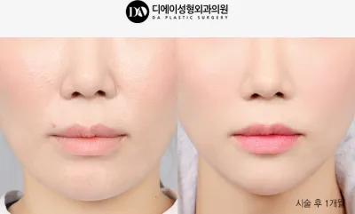 Before & After