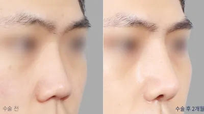 Before & After