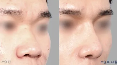 Before & After