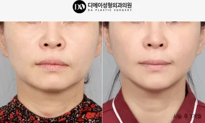 Before & After