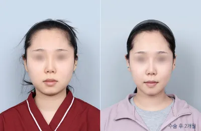Before & After