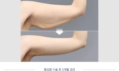 Before & After