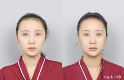 Before & After