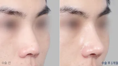 Before & After