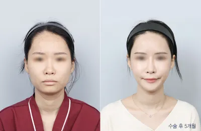 Before & After