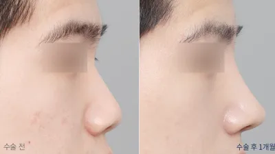Before & After