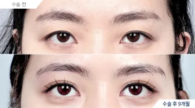 Before & After