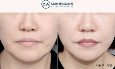 Before & After