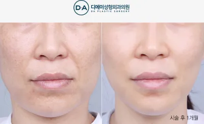 Before & After