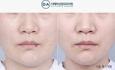 Before & After