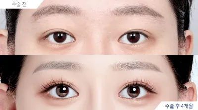Before & After