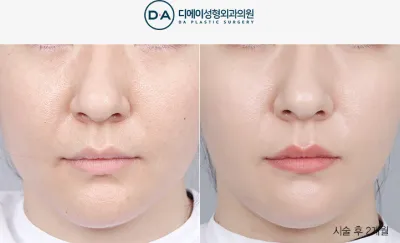 Before & After