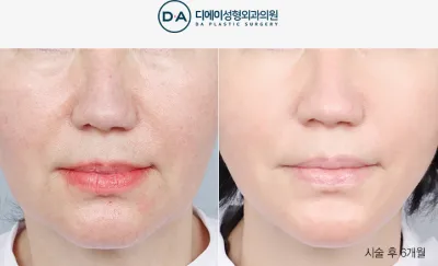 Before & After