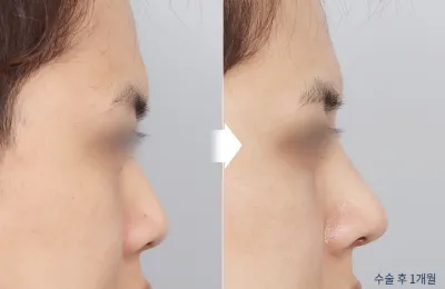 Before & After