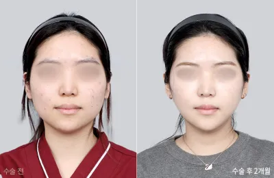 Before & After