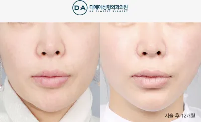 Before & After