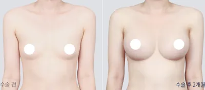 Before & After