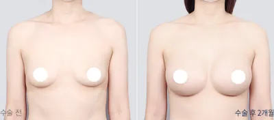 Before & After