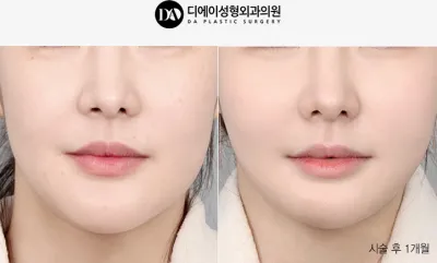 Before & After
