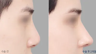 Before & After