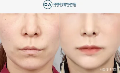 Before & After