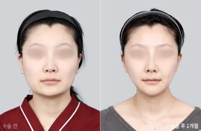 Before & After