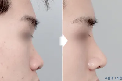 Before & After