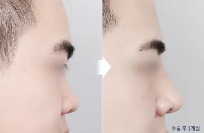 Before & After