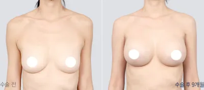 Before & After