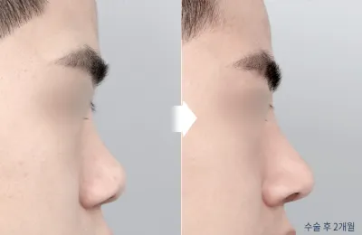 Before & After