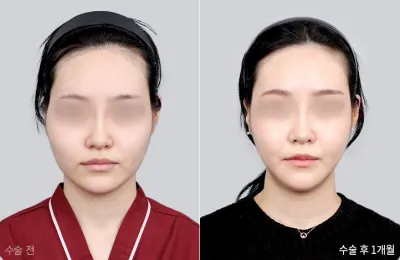 Before & After