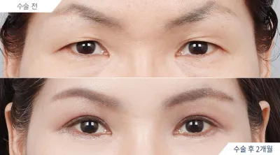 Before & After