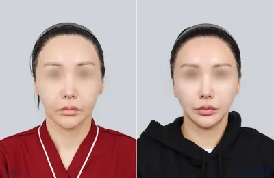 Before & After