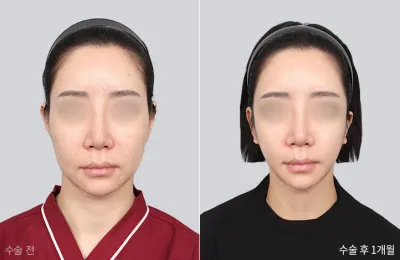Before & After