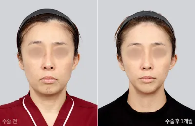 Before & After