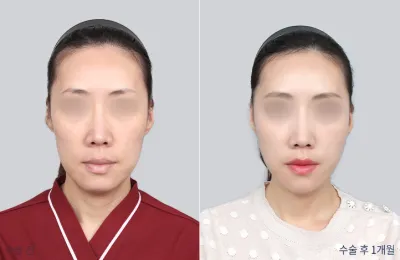Before & After