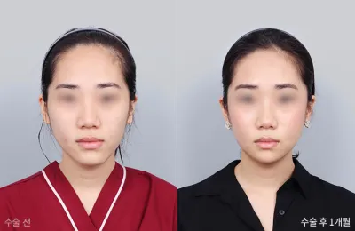 Before & After