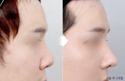 Before & After