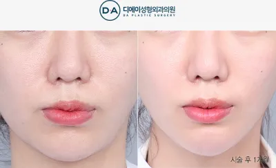 Before & After