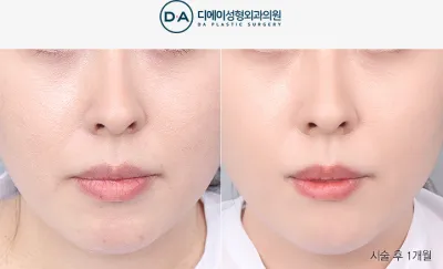 Before & After