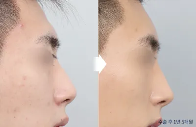 Before & After
