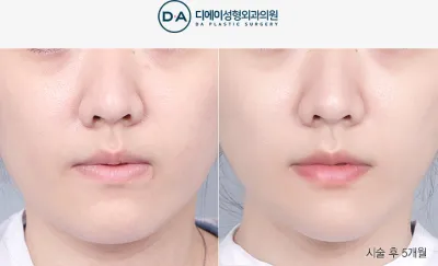 Before & After