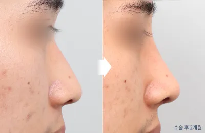 Before & After
