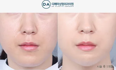 Before & After