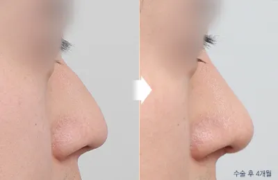 Before & After