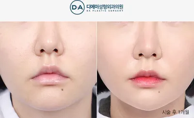 Before & After