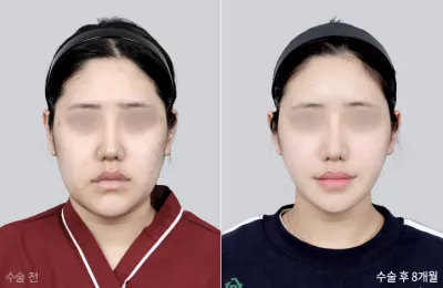 Before & After
